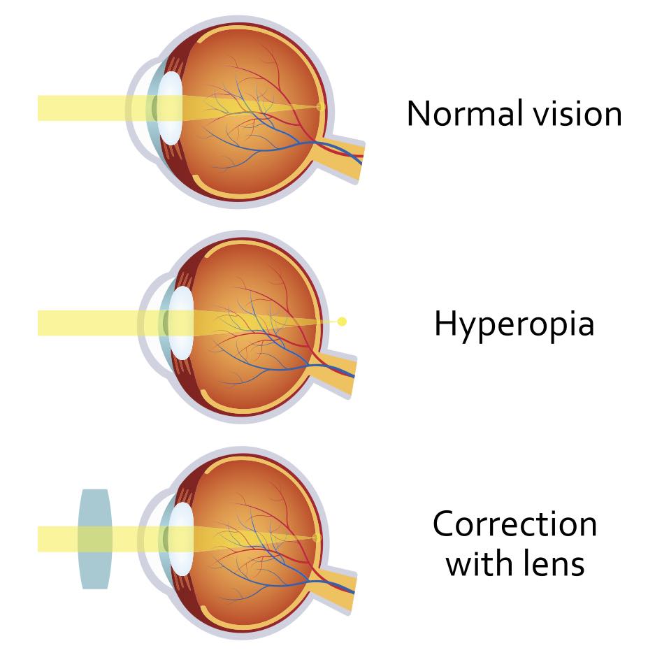 Hyperopia eyeball