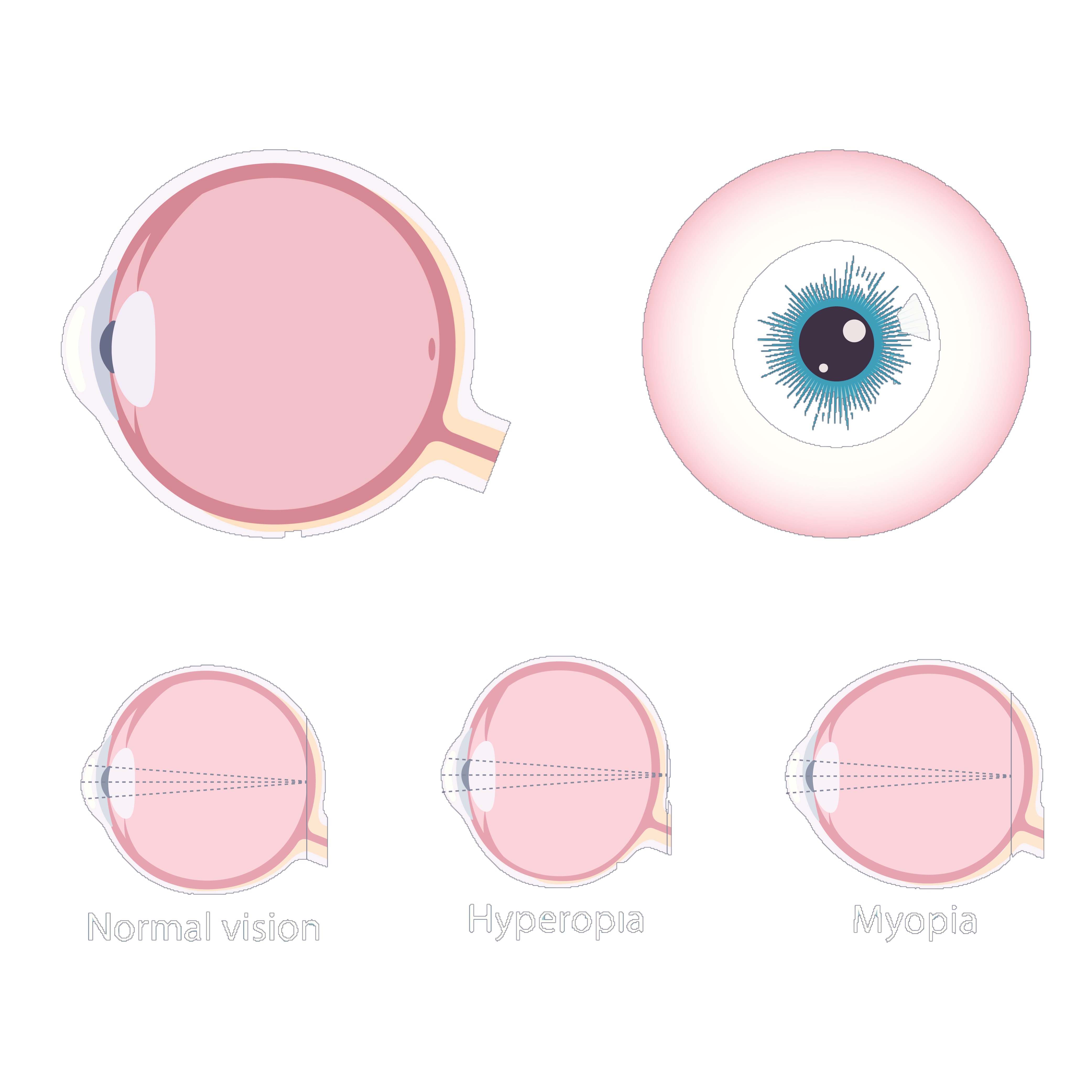 How myopia changes your eyeball
