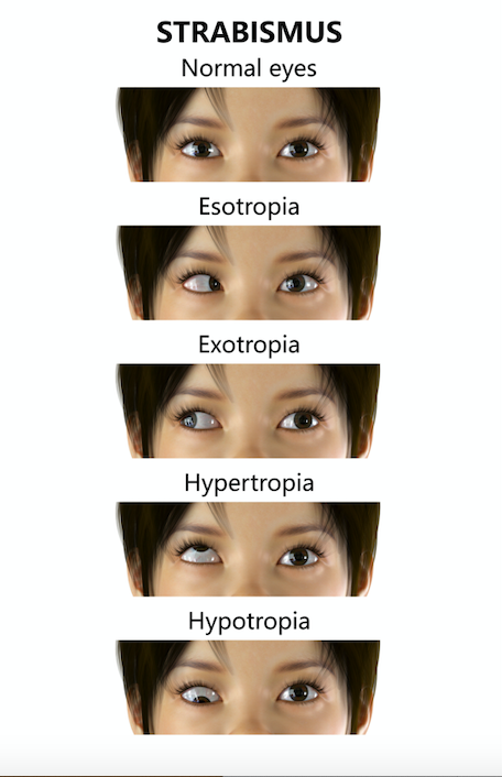 The various types of Strabismus